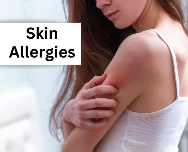 Skin Allergies