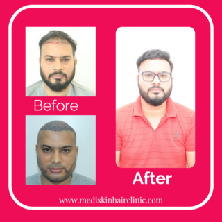 hair transplant treatment in kharadi wagholi pune