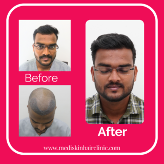 best hair transplant in kharadi, wagholi, pune | Dr. Shreedevi Lakhe