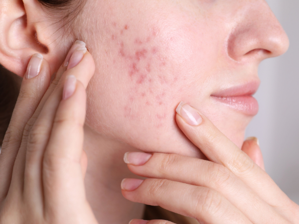 Acne Scars Treatment in Kharadi, Pune | Dr. Shridevi Lakhe