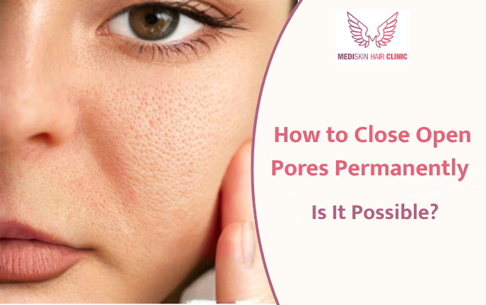 How to Close Open Pores Permanently – Is It Really Possible?