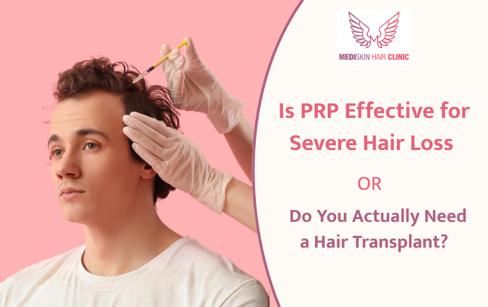 Is PRP Effective for Severe Hair Loss — or Do You Actually Need a Hair Transplant?