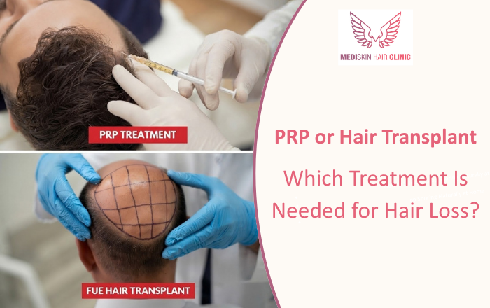 PRP or Hair Transplant: Which Treatment Is Needed for Hair Loss?